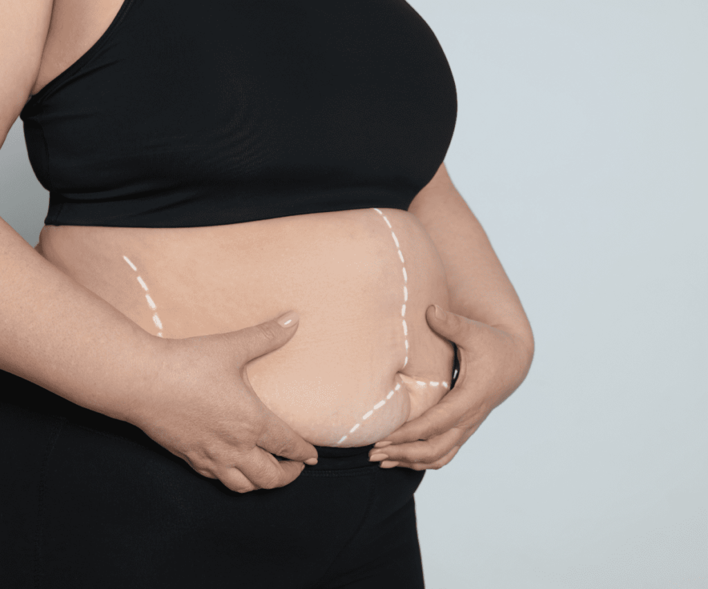 Tudo Sobre Cirurgia Bariátrica