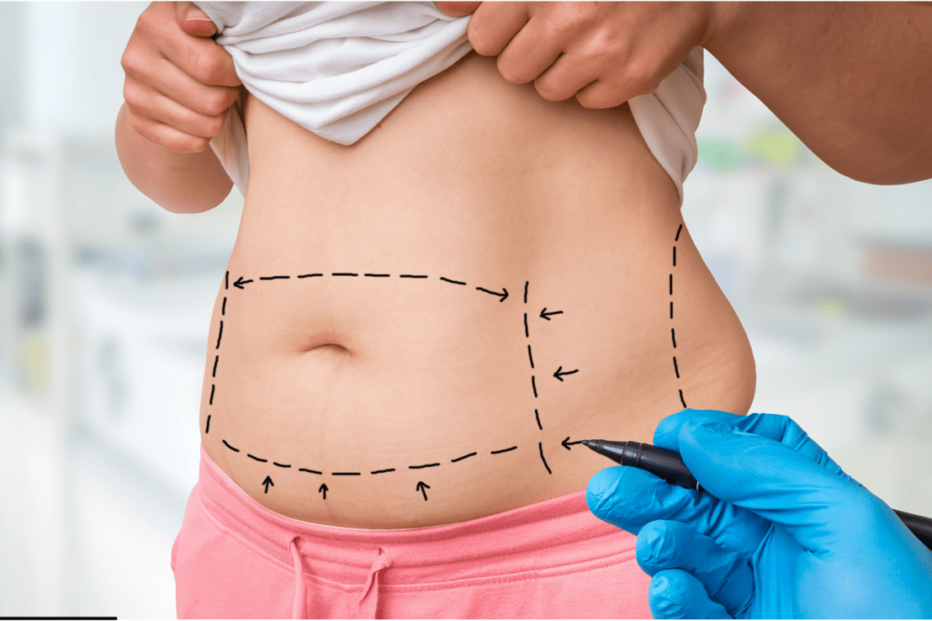 Lipoaspiração, tudo que você precisa saber sobre o procedimento