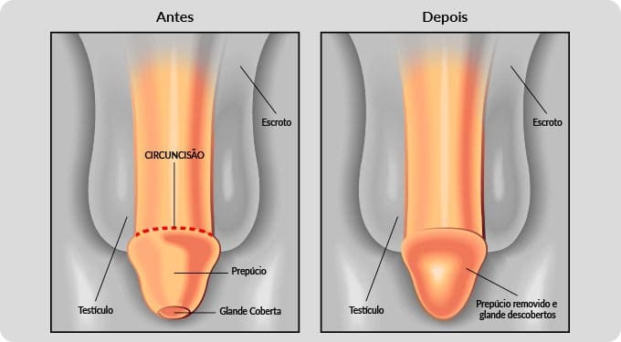 Postectomia antes e depois do procedimento