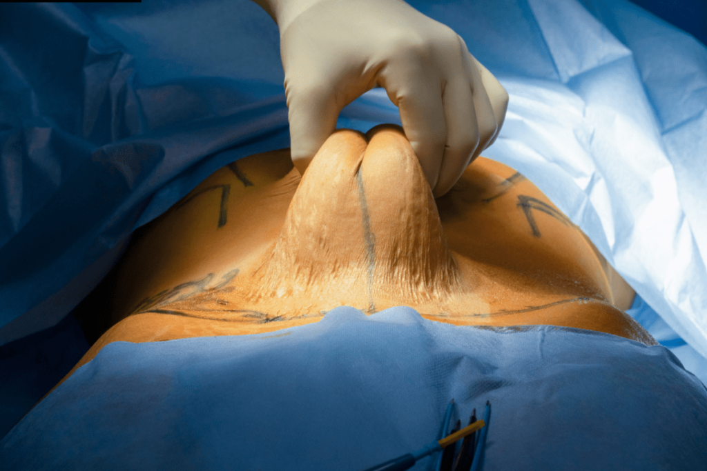 Saiba se a Unimed cobre Abdominoplastia