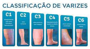 como eliminar as varizes